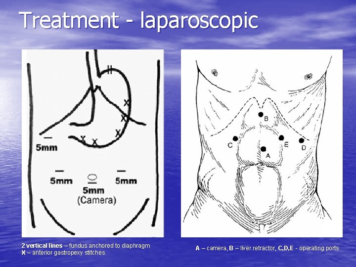 Treatment - laparoscopic 2 vertical lines – fundus anchored to diaphragm X – anterior