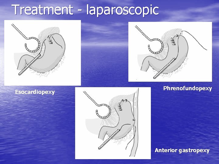 Treatment - laparoscopic Esocardiopexy Phrenofundopexy Anterior gastropexy 