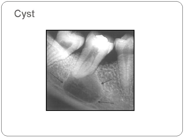  Cyst 