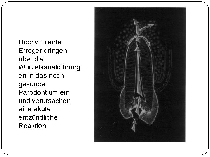 Hochvirulente Erreger dringen über die Wurzelkanalöffnung en in das noch gesunde Parodontium ein und