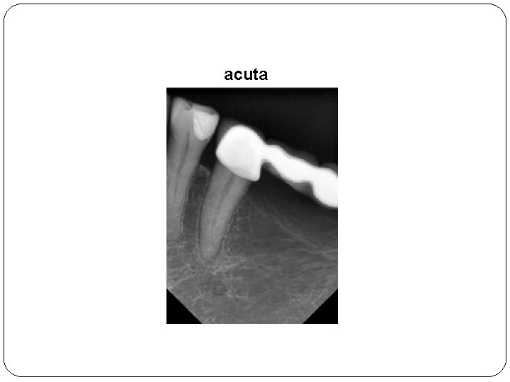 acuta 