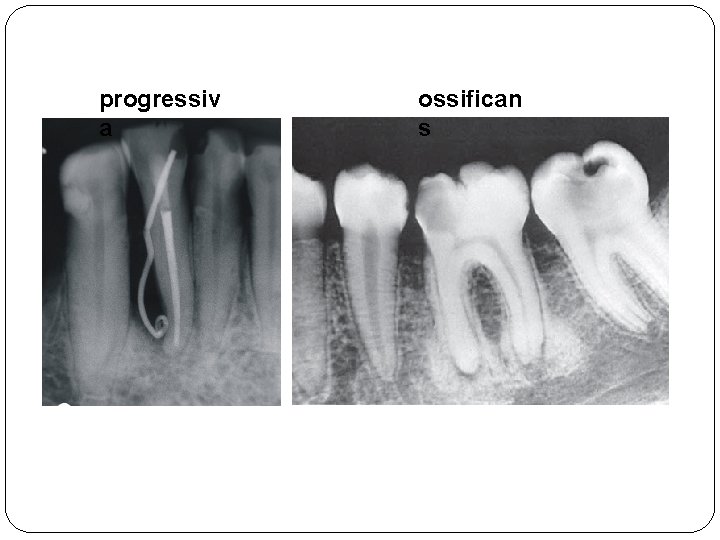 progressiv a ossifican s 