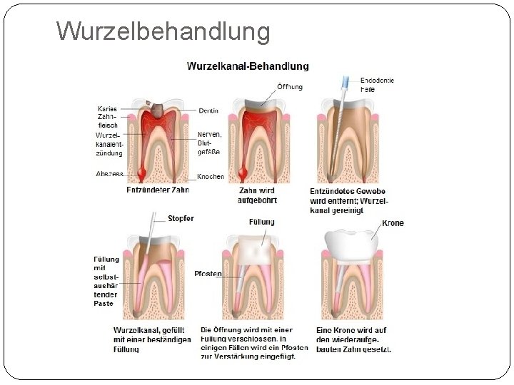 Wurzelbehandlung 