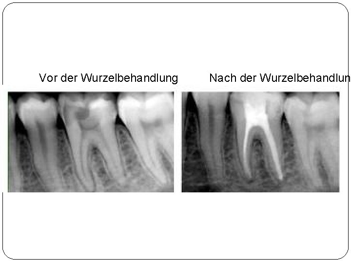 Vor der Wurzelbehandlung Nach der Wurzelbehandlung 