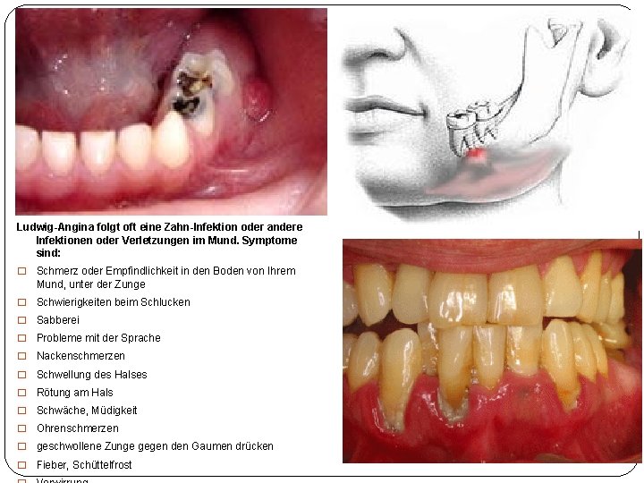 Ludwig-Angina folgt oft eine Zahn-Infektion oder andere Infektionen oder Verletzungen im Mund. Symptome sind: