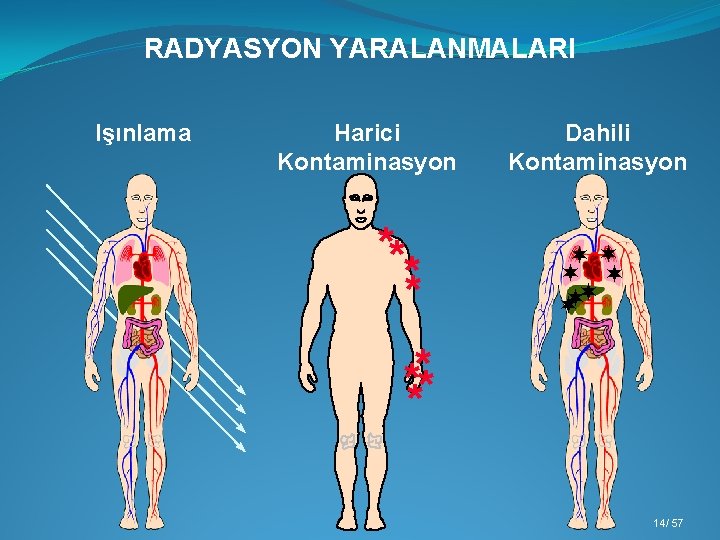 RADYASYON YARALANMALARI Işınlama Harici Kontaminasyon ** ** Dahili Kontaminasyon ¬¬ ¬ ¬ **** 14/