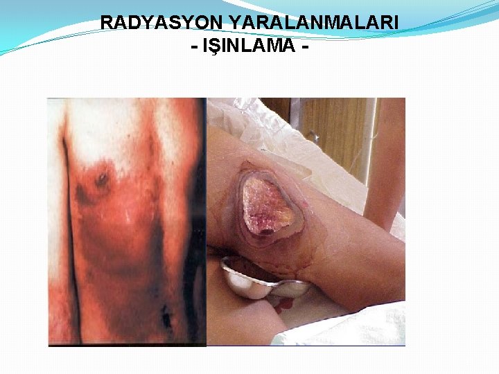 RADYASYON YARALANMALARI - IŞINLAMA - 16 