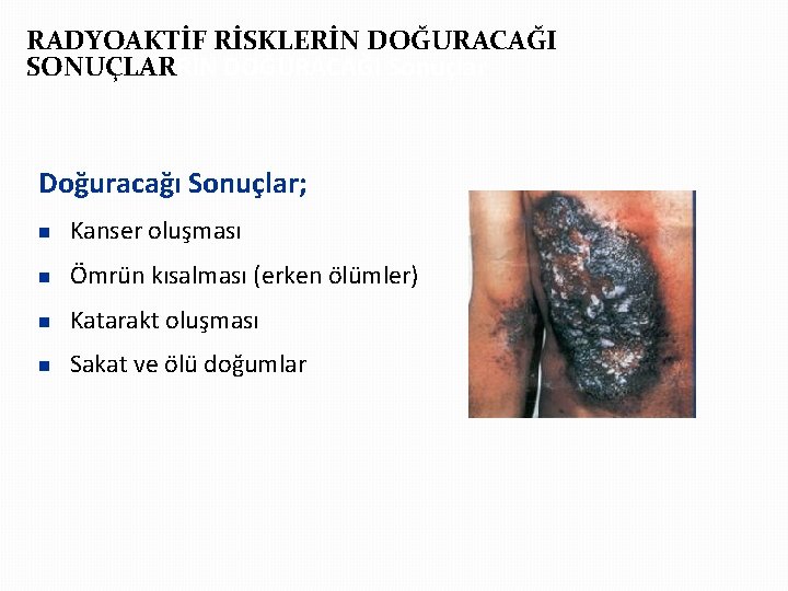 RADYOAKTİF RİSKLERİN DOĞURACAĞI SONUÇLARRİN DOĞURACAĞI Sonuçlar Doğuracağı Sonuçlar; n Kanser oluşması n Ömrün kısalması