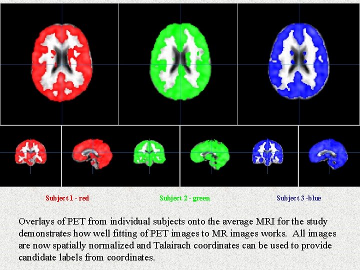 Subject 1 - red Subject 2 - green Subject 3 -blue Overlays of PET