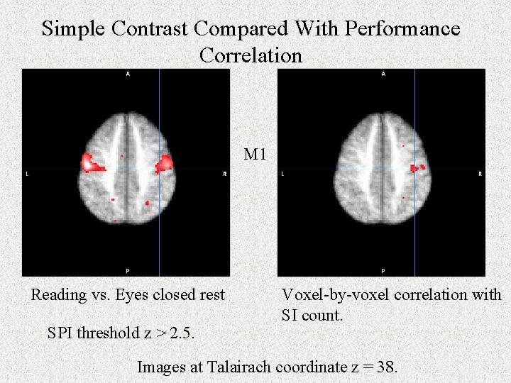 Simple Contrast Compared With Performance Correlation M 1 Reading vs. Eyes closed rest SPI