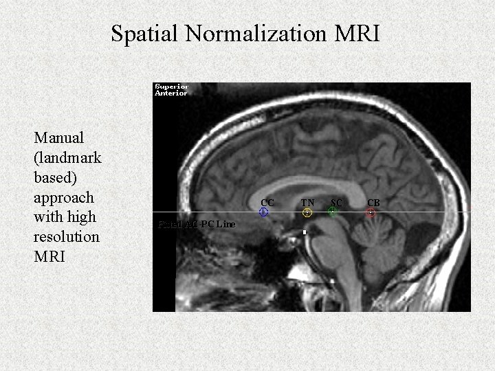 Spatial Normalization MRI Manual (landmark based) approach with high resolution MRI CC Fitted AC-PC