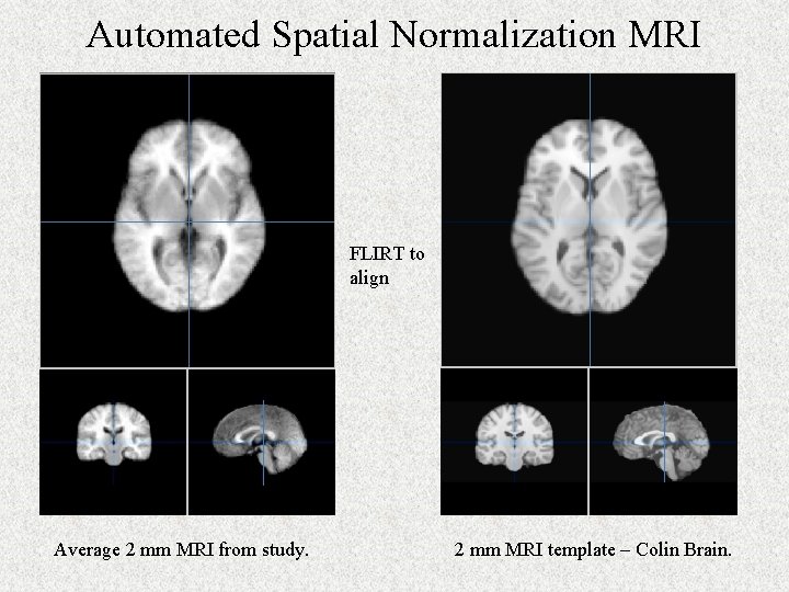 Automated Spatial Normalization MRI FLIRT to align Average 2 mm MRI from study. 2