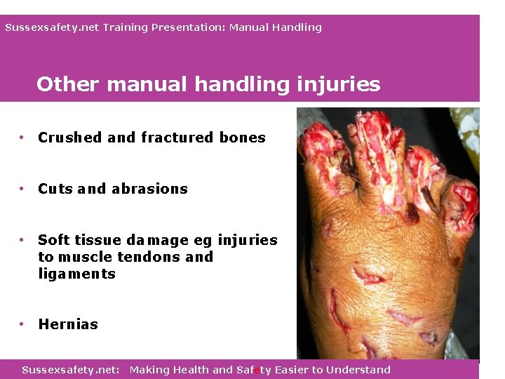 Sussexsafety. net Training Presentation: Manual Handling Other manual handling injuries • Crushed and fractured