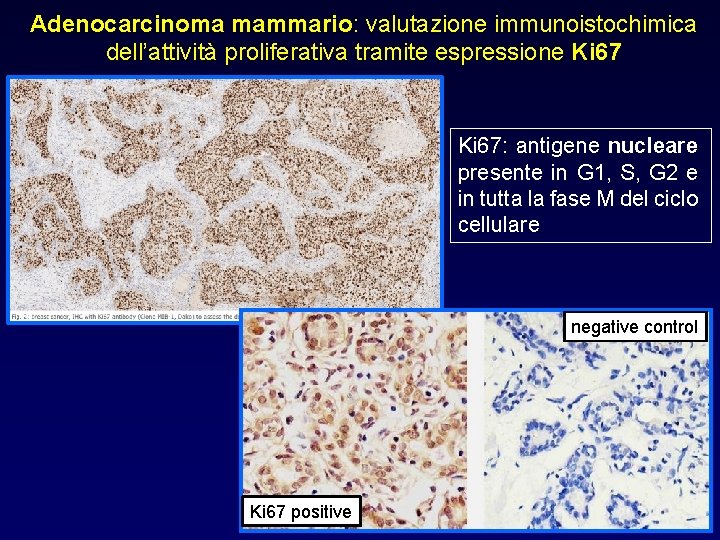 Adenocarcinoma mammario: valutazione immunoistochimica dell’attività proliferativa tramite espressione Ki 67: antigene nucleare presente in Adenocarcinoma mammario: valutazione immunoistochimica dell’attività proliferativa tramite espressione Ki 67: antigene nucleare presente in