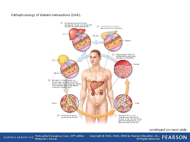 Pathophysiology of diabetic ketoacidosis (DKA). continued on next slide Prehospital Emergency Care, 10 th