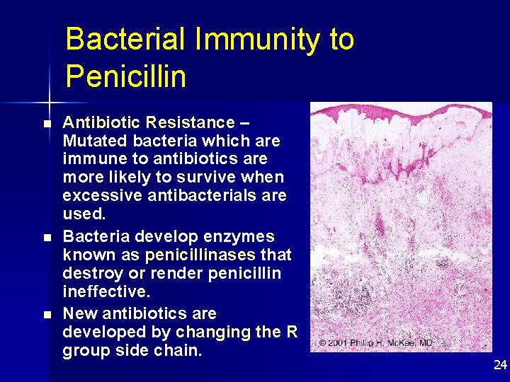 Bacterial Immunity to Penicillin n Antibiotic Resistance – Mutated bacteria which are immune to