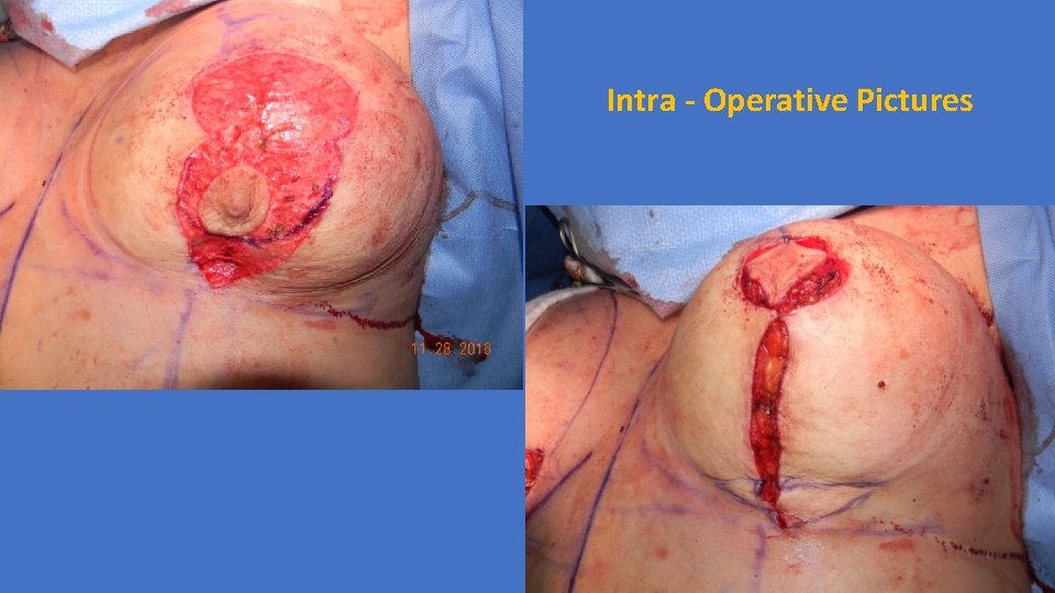 Intra - Operative Pictures 