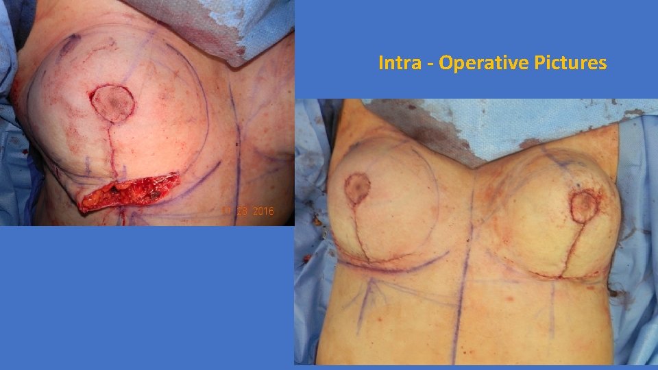 Intra - Operative Pictures 