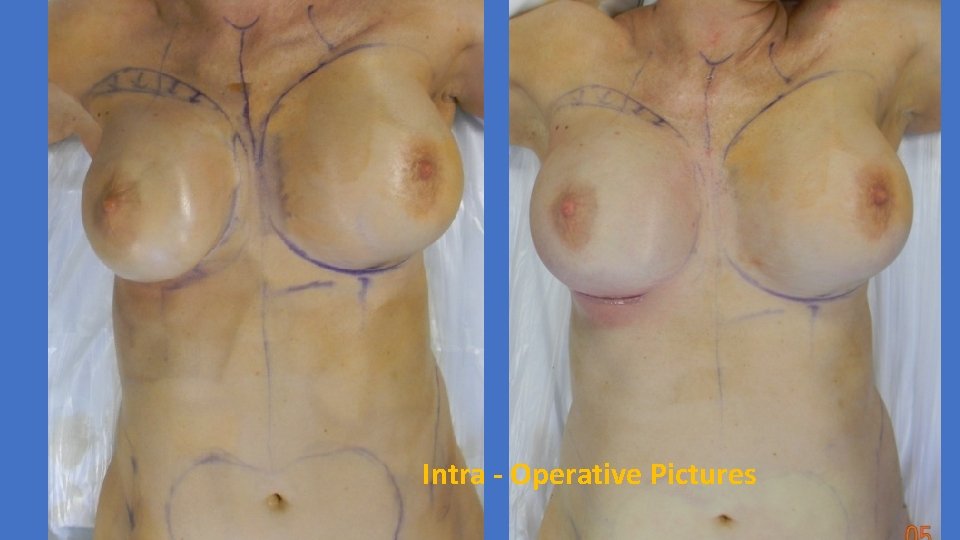 Intra - Operative Pictures 