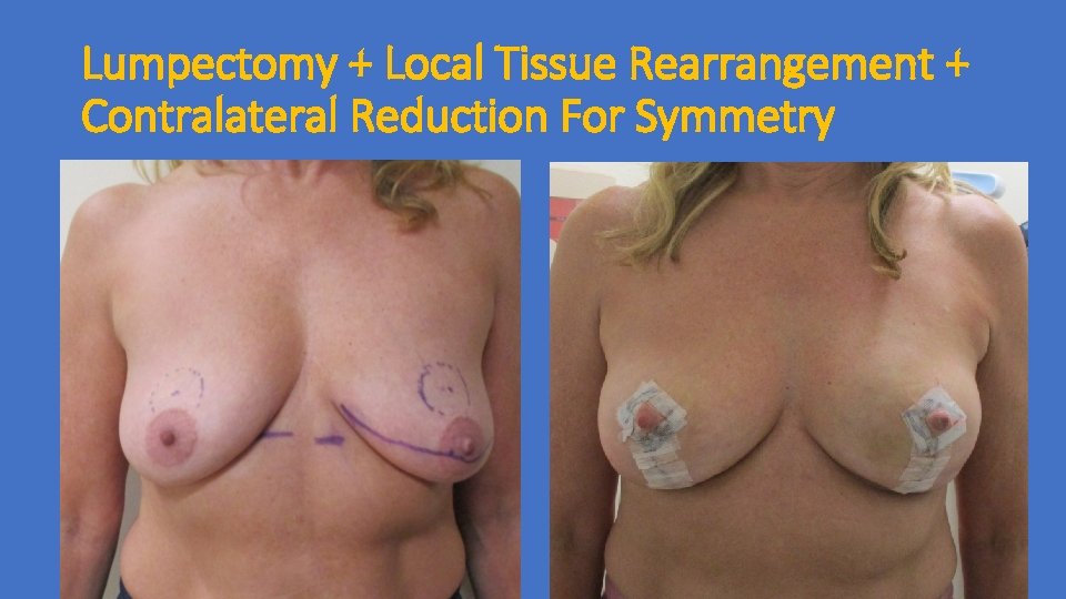 Lumpectomy + Local Tissue Rearrangement + Contralateral Reduction For Symmetry Lumpectomy + Local Tissue Rearrangement + Contralateral Reduction For Symmetry