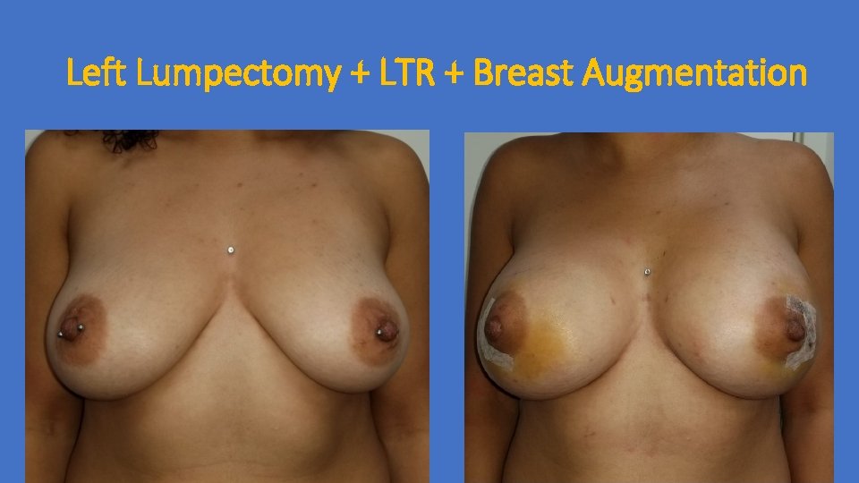 Left Lumpectomy + LTR + Breast Augmentation 