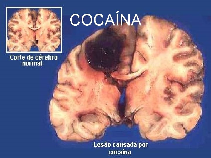 COCAÍNA 