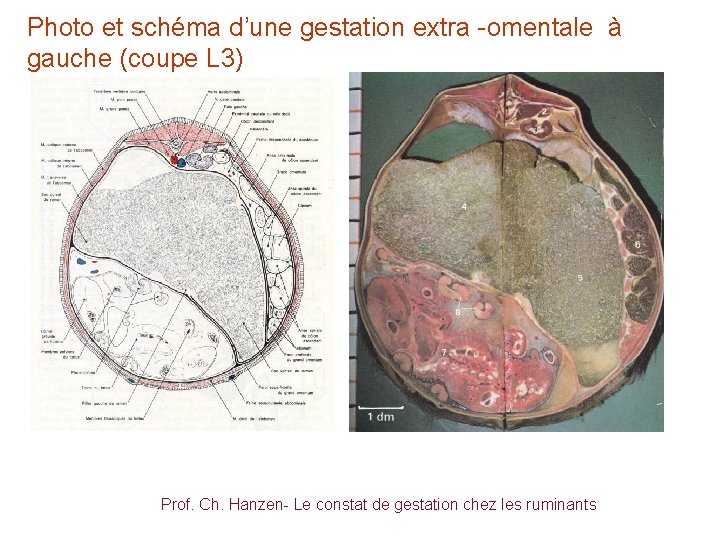 Photo et schéma d’une gestation extra -omentale à gauche (coupe L 3) Prof. Ch.