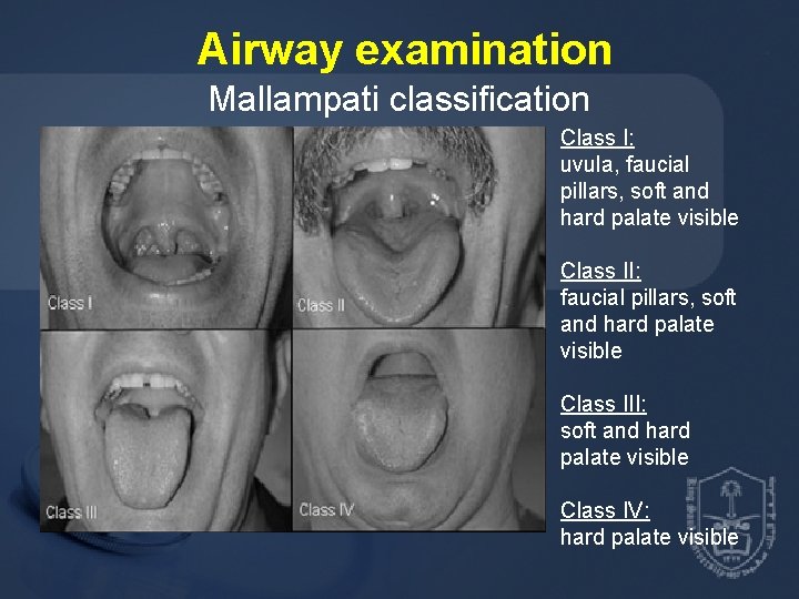 Airway examination Mallampati classification Class I: uvula, faucial pillars, soft and hard palate visible