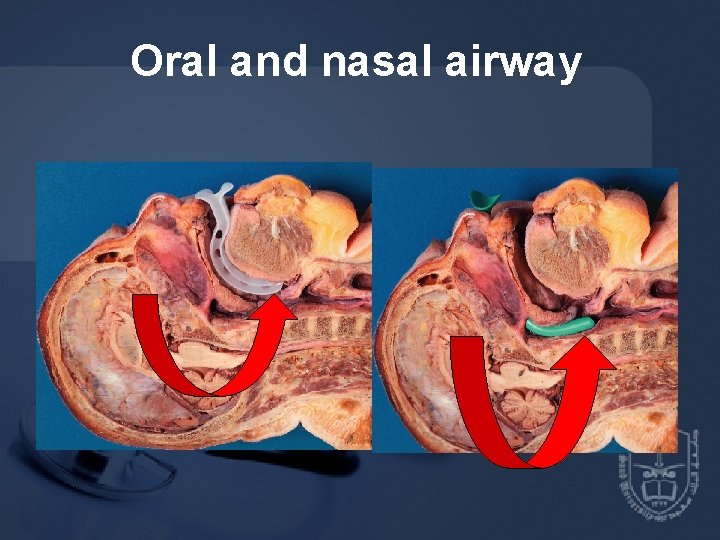 Oral and nasal airway 