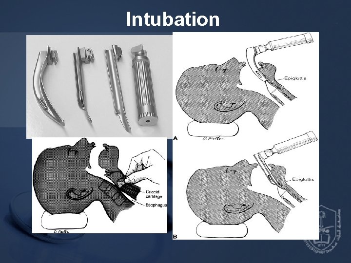 Intubation 