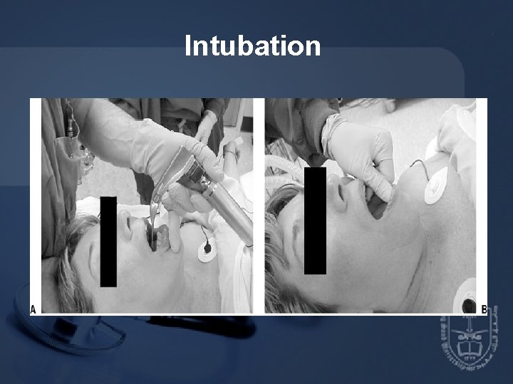 Intubation 