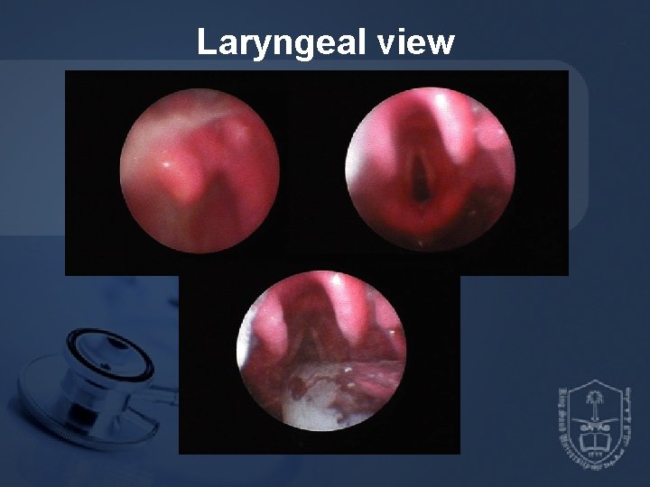 Laryngeal view 