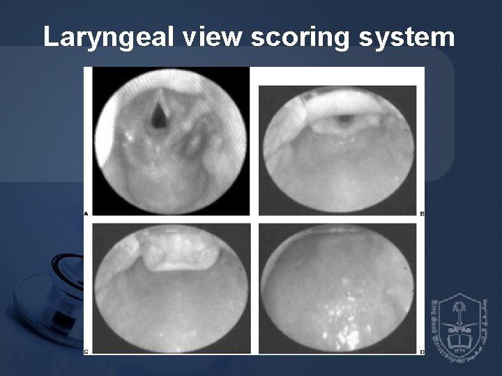 Laryngeal view scoring system 