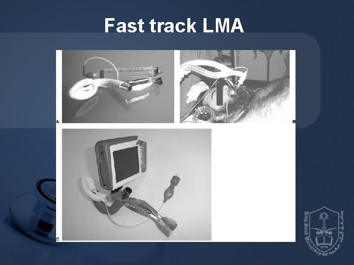 Fast track LMA 