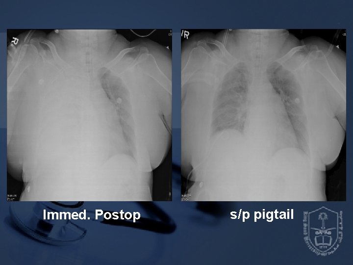 Immed. Postop s/p pigtail 