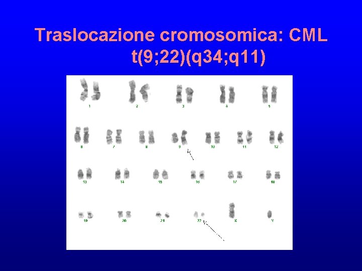 Traslocazione cromosomica: CML t(9; 22)(q 34; q 11) 