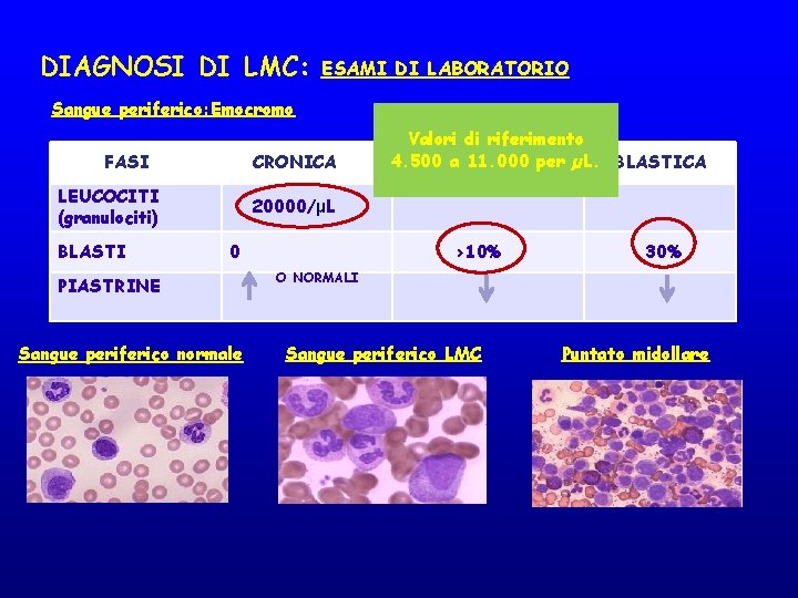 DIAGNOSI DI LMC: ESAMI DI LABORATORIO Sangue periferico: Emocromo FASI CRONICA LEUCOCITI (granulociti) BLASTI