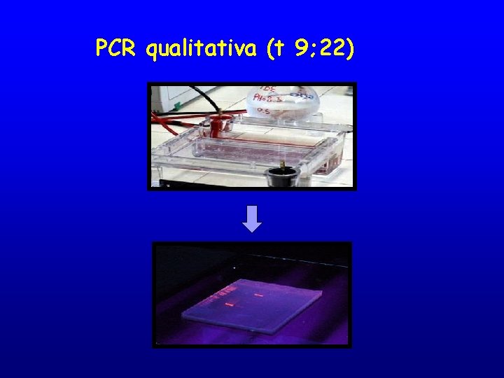 PCR qualitativa (t 9; 22) 
