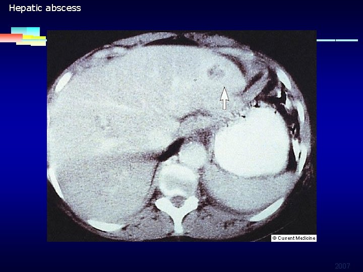 Hepatic abscess 2007 