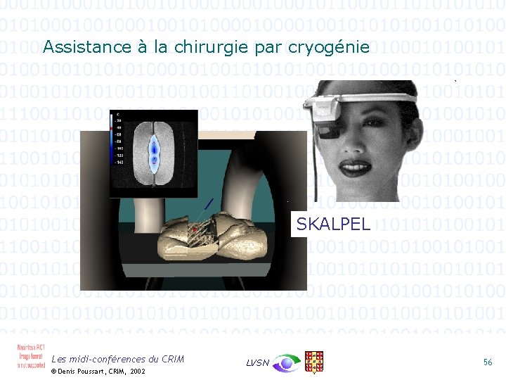 Assistance à la chirurgie par cryogénie SKALPEL Les midi-conférences du CRIM © Denis Poussart,