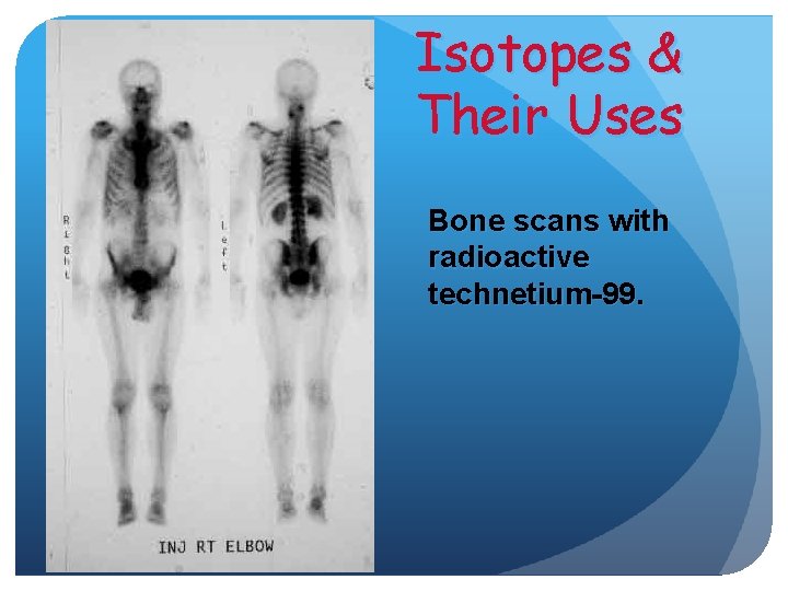 Isotopes & Their Uses Bone scans with radioactive technetium-99. 