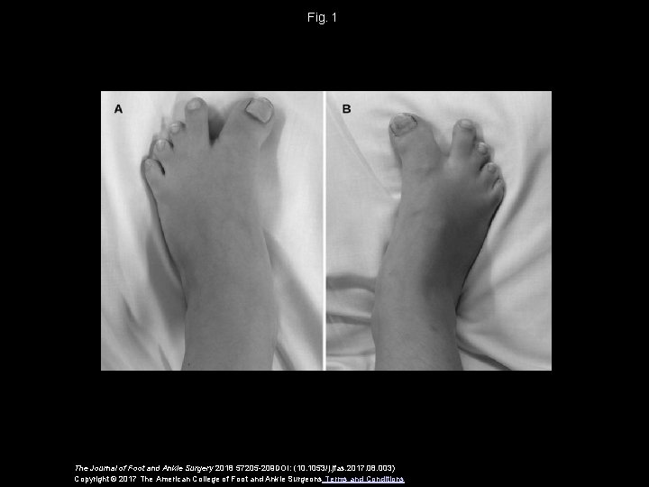 Fig.  1 The Journal of Foot and Ankle Surgery 2018 57205 -209 DOI: (10.