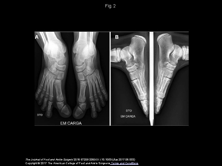 Fig.  2 The Journal of Foot and Ankle Surgery 2018 57205 -209 DOI: (10.