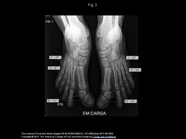 Fig.  3 The Journal of Foot and Ankle Surgery 2018 57205 -209 DOI: (10.