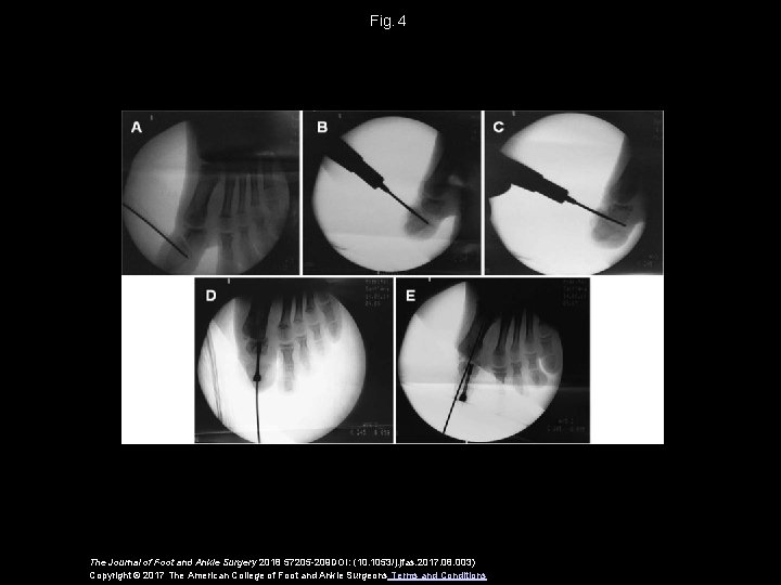 Fig.  4 The Journal of Foot and Ankle Surgery 2018 57205 -209 DOI: (10.