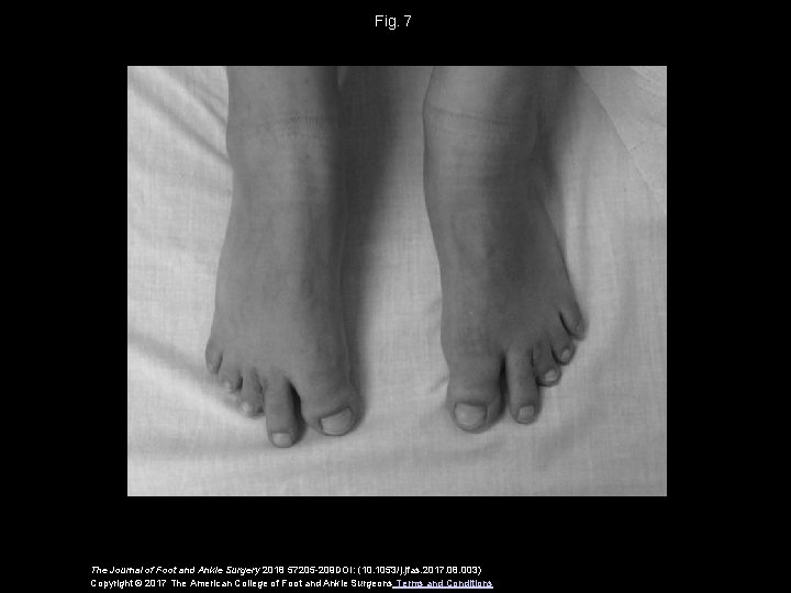 Fig.  7 The Journal of Foot and Ankle Surgery 2018 57205 -209 DOI: (10.