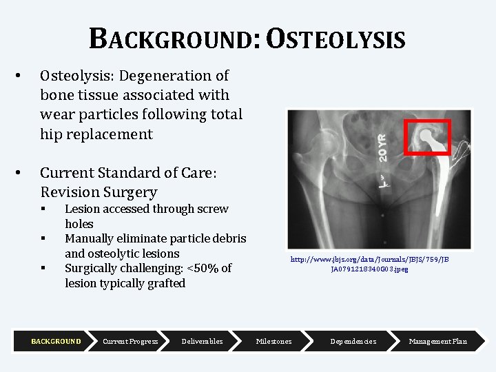 BACKGROUND: OSTEOLYSIS • Osteolysis: Degeneration of bone tissue associated with wear particles following total