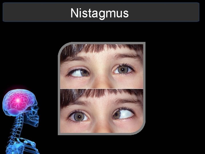 Nistagmus 
