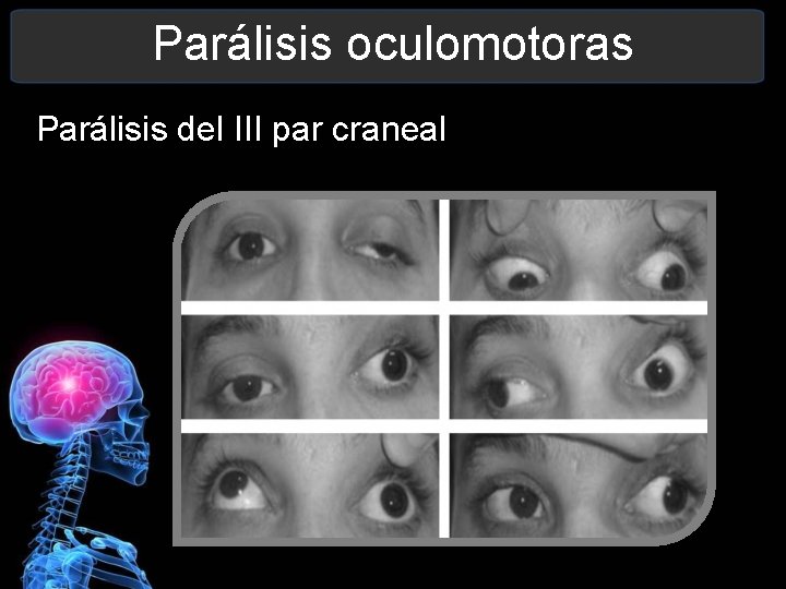 Parálisis oculomotoras Parálisis del III par craneal 