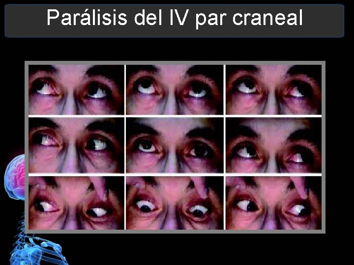 Parálisis del IV par craneal 